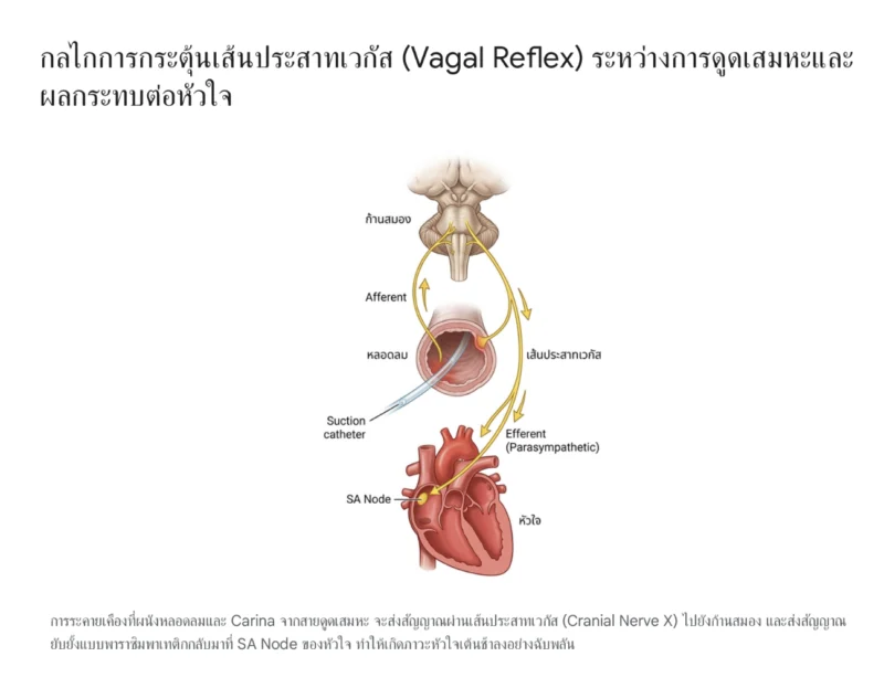 ภาพจำลองทางกายวิภาคแสดงกลไก Vagal Reflex ระหว่างการดูดเสมหะ อธิบายกระบวนการที่สายดูดเสมหะทำให้เกิดการระคายเคืองที่หลอดลม ส่งสัญญาณผ่านเส้นประสาทเวกัสไปยังก้านสมอง และส่งสัญญาณพาราซิมพาเทติกกลับมากระตุ้น SA Node ที่หัวใจ ทำให้หัวใจเต้นช้าลงฉับพลัน
